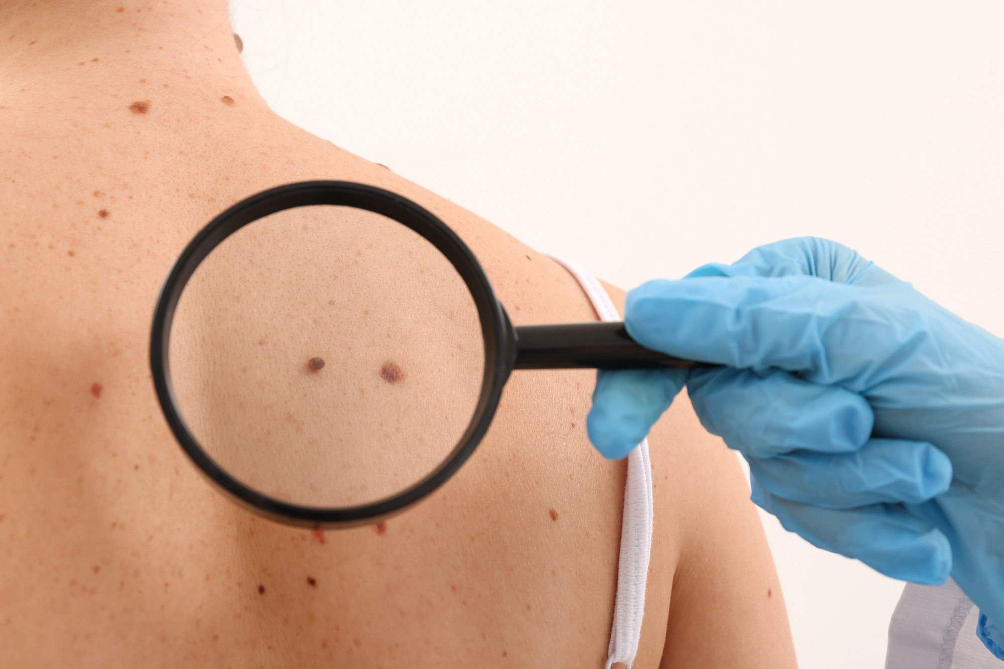 Danes vemo, da je kožni rak bolezen, ki jo lahko premagamo